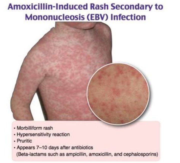 Can amoxicillin cause a rash after 7 days?