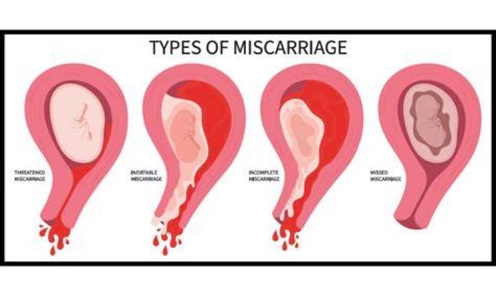 Can Crocin cause miscarriage?