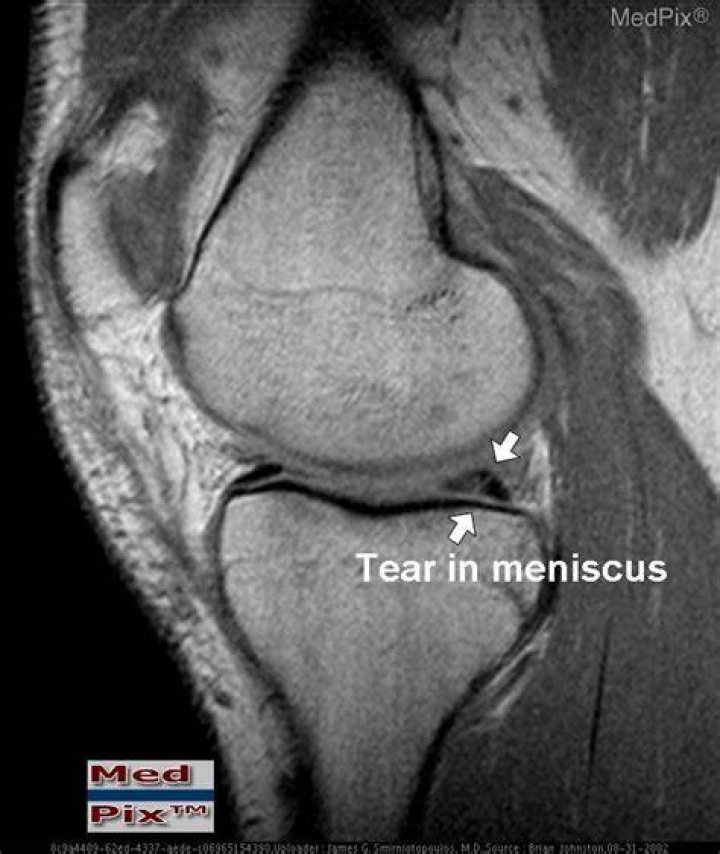 Can you see a meniscus tear on an MRI?