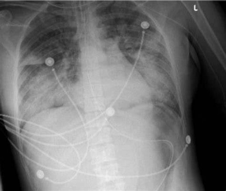 Do you need a chest X ray after intubation?