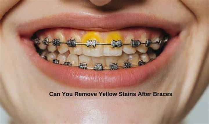 How do I get rid of yellow stains on my teeth from braces?