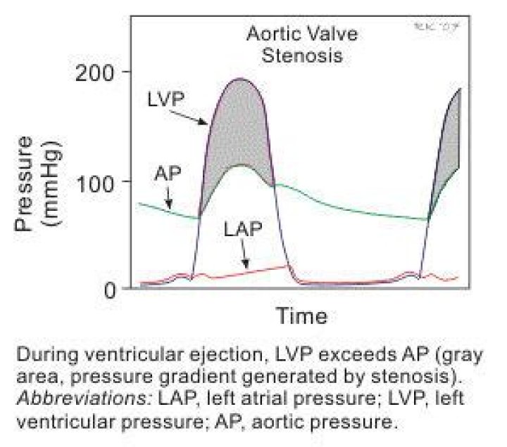 How do you calculate the aortic pressure gradient?