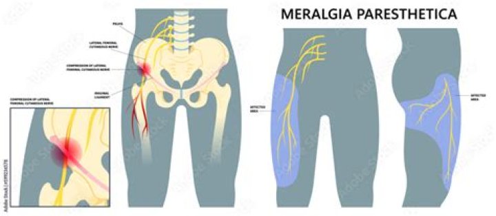 How do you get rid of meralgia paresthetica?