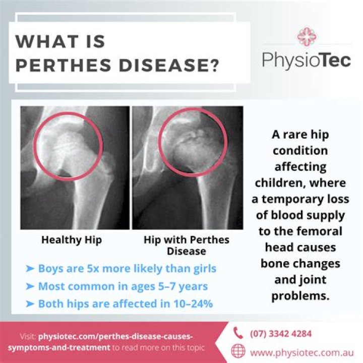 How do you manage Perthes disease?