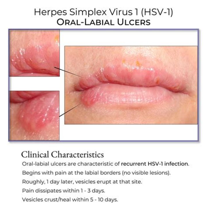 How do you permanently cure herpes simplex 1?