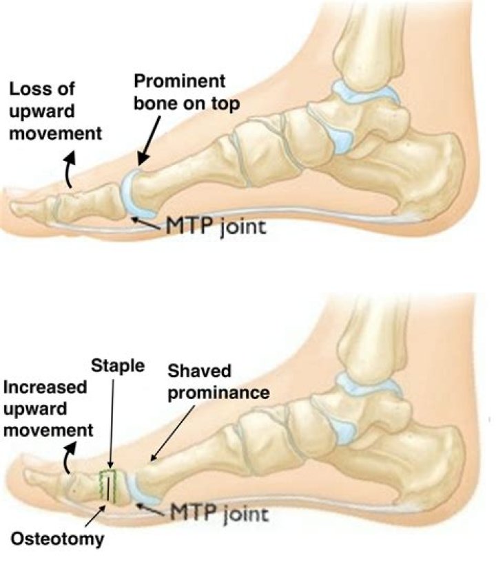 How do you treat an MTP joint?