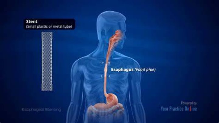 How long can you live with a stent in your esophagus?