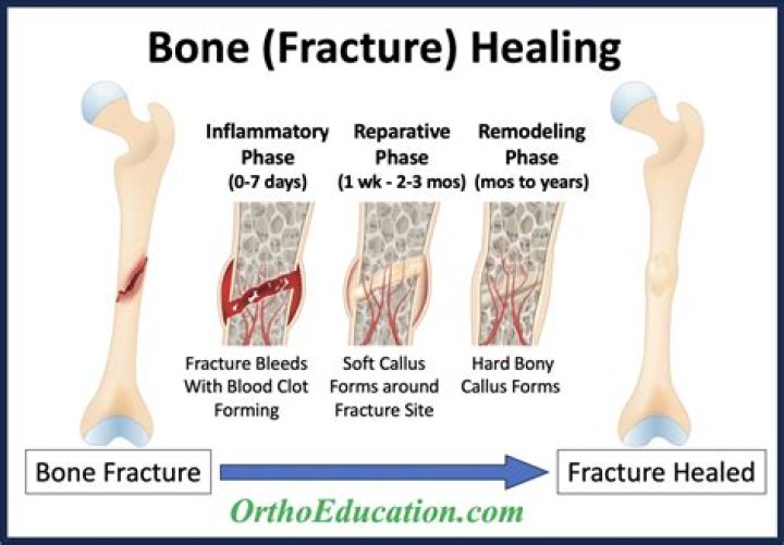 How long does it take for an occult fracture to heal?