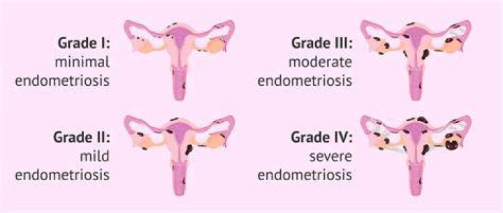 How many grades of endometriosis are there?