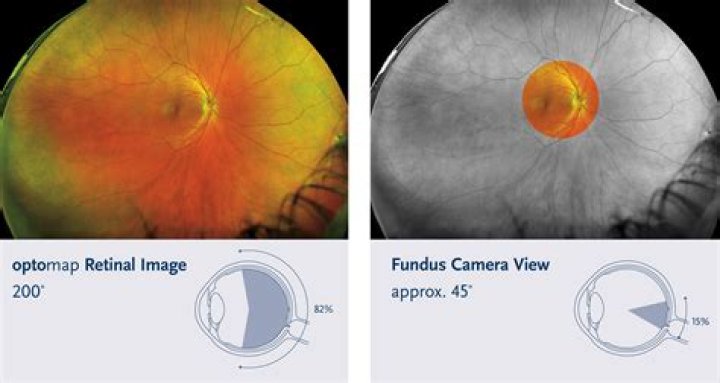 Is optomap same as fundus photography?
