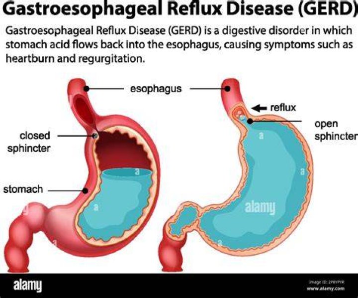 What are reflux changes?