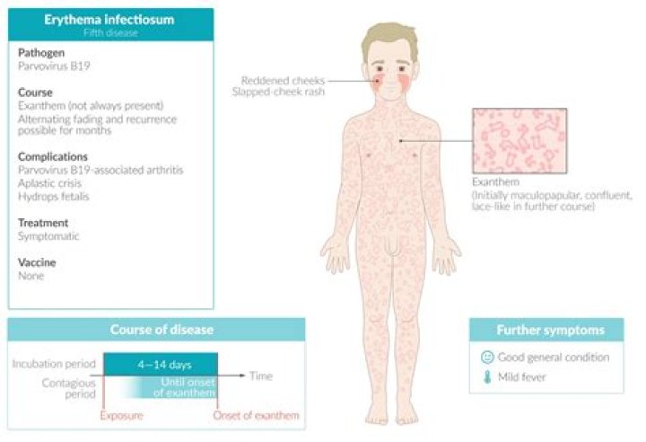What are the symptoms of parvovirus B19?