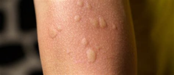 What do allergy bumps look like?