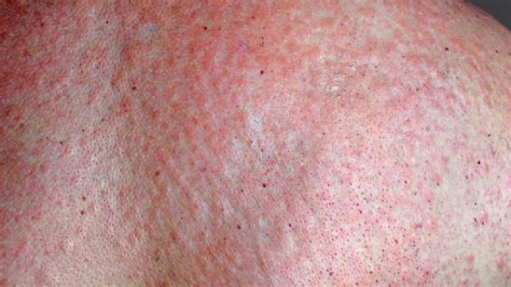 What does a strep skin rash look like?