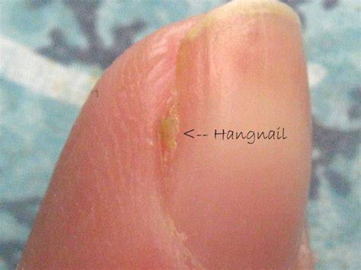 What does it mean to have hang nails?