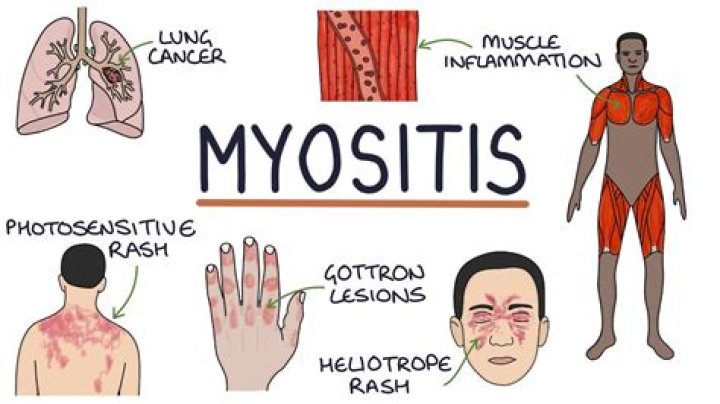 What does myositis rash look like?
