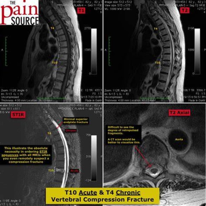 What is a T1 fracture?