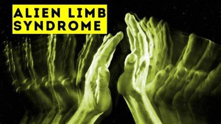 What is alien limb phenomenon?