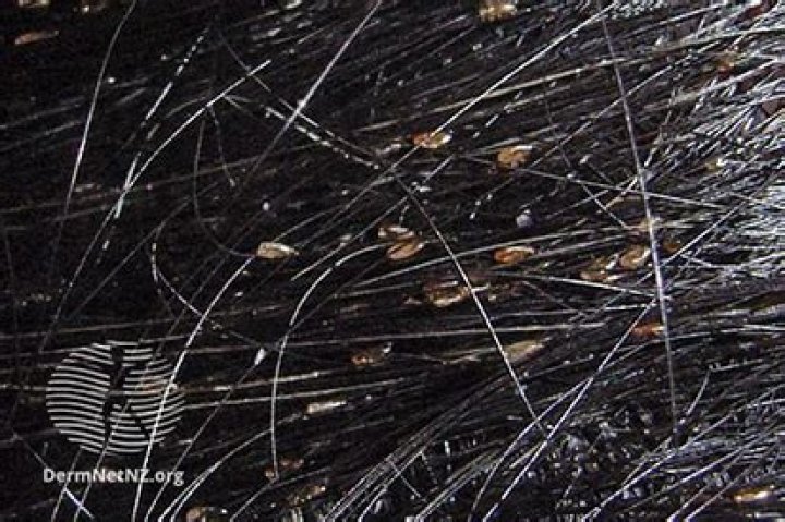 What is considered a severe lice infestation?