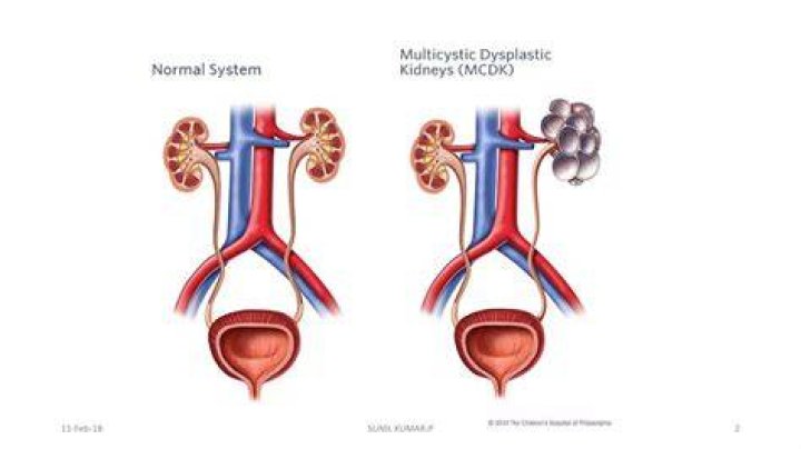 What is cystic dysplastic kidney?