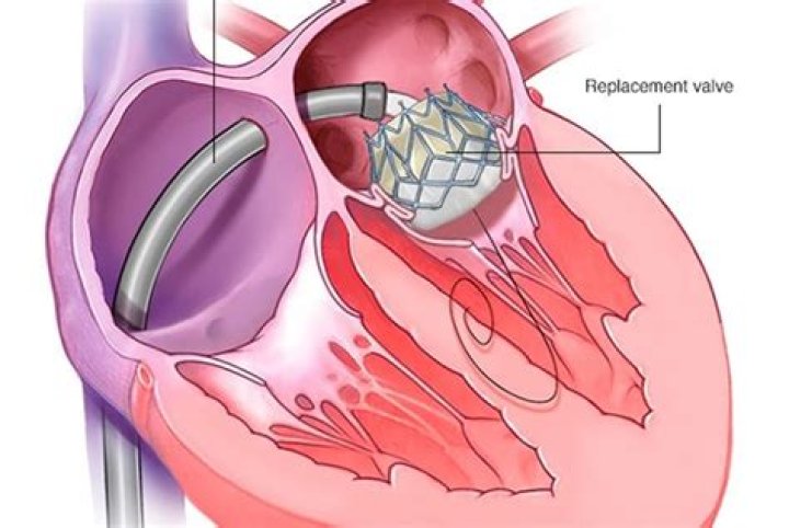 What is DVR surgery?