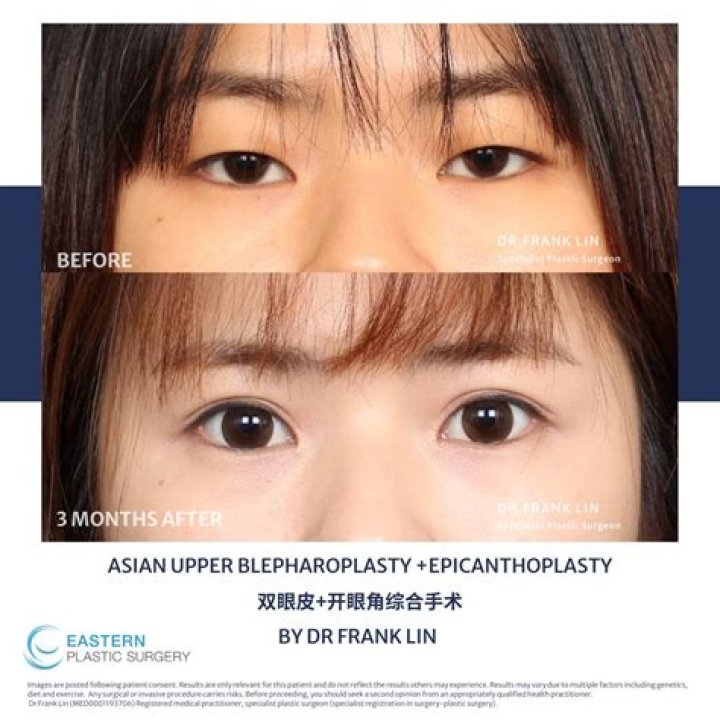 What is epicanthoplasty surgery?