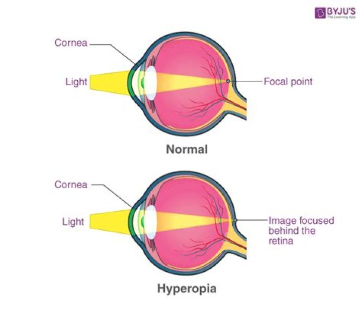 What is high hypermetropia?