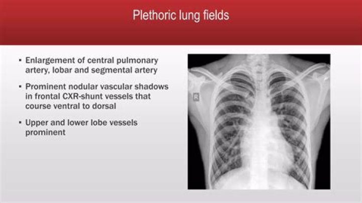 What is Plethoric lung field?