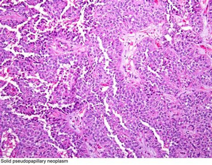 What is pseudopapillary neoplasm?