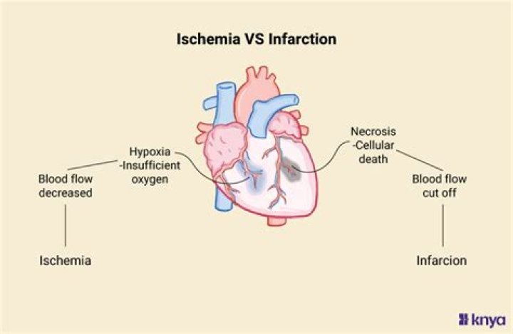 What is the difference between infarction and ischemia?