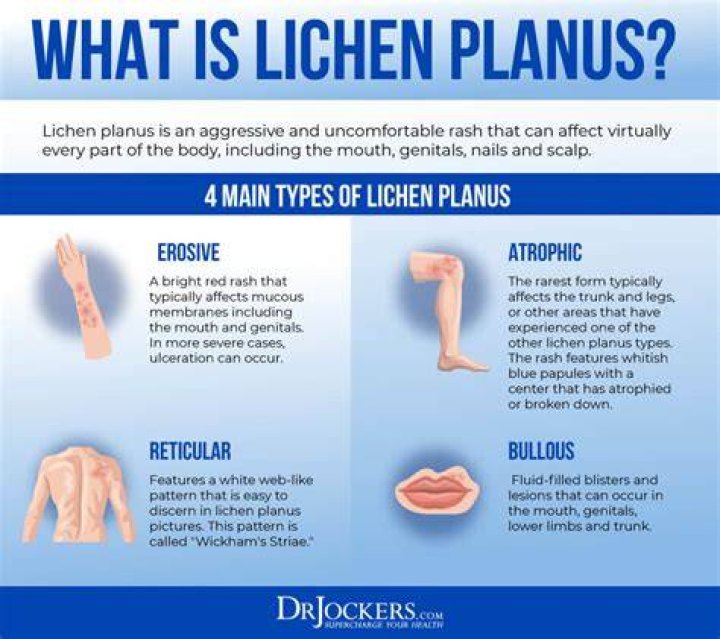 What is the main cause of lichen planus?
