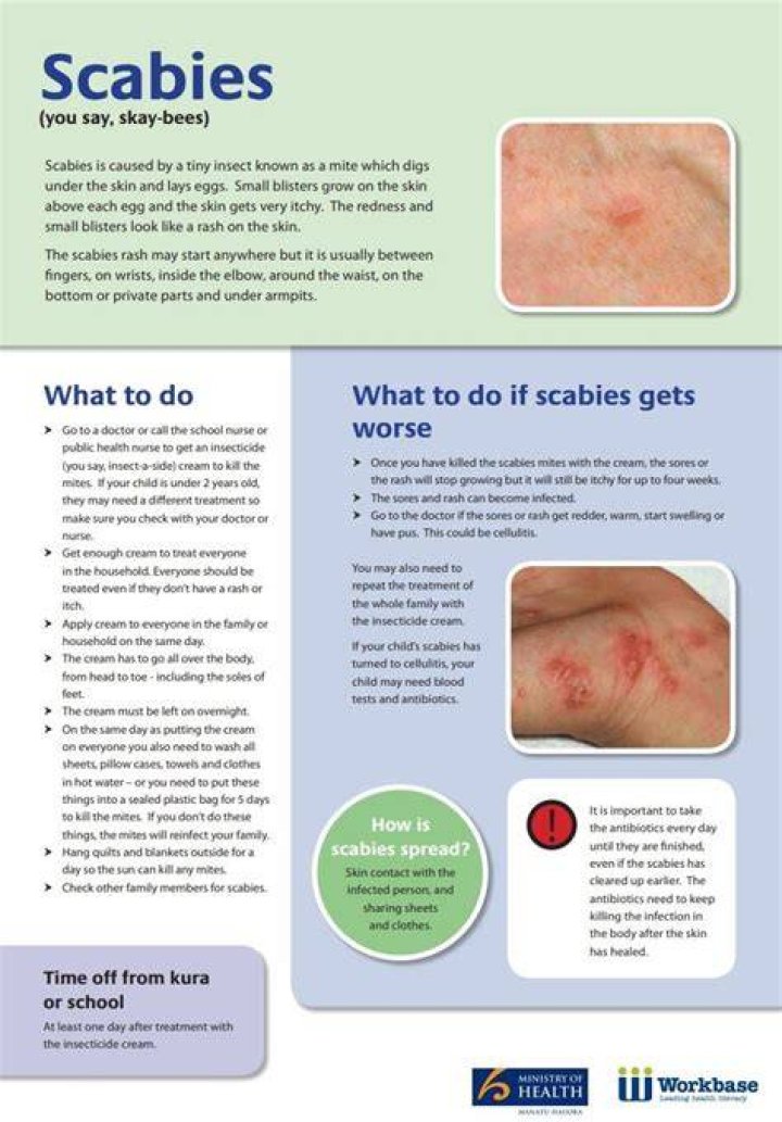 What is the most common treatment for scabies?