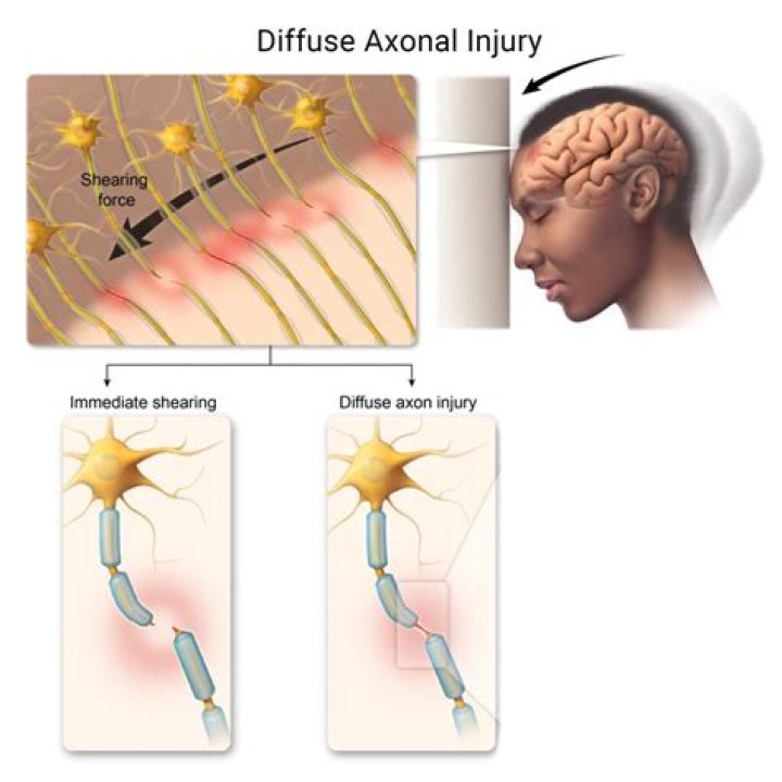 What is the prognosis after diffuse axonal injury?
