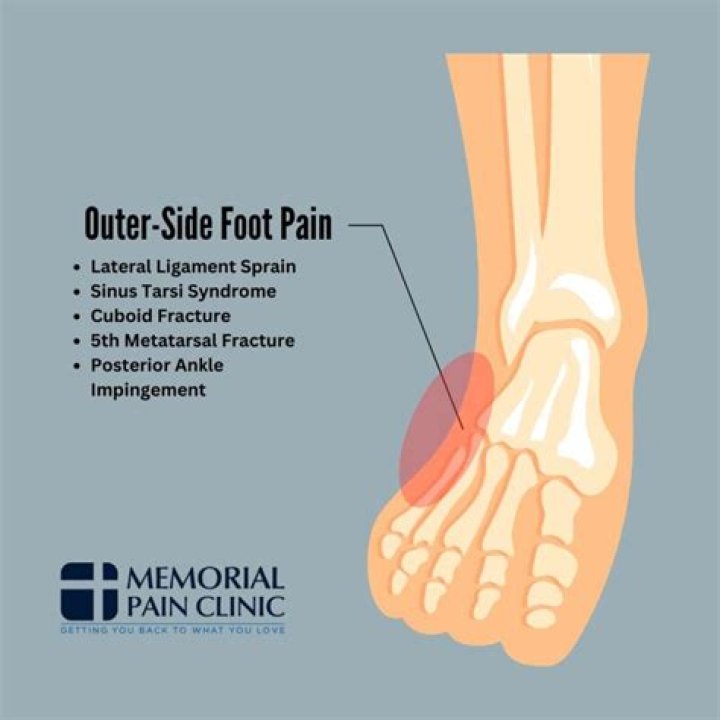 What makes the outside of your foot hurt?