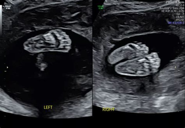 What should I expect at my 19 week ultrasound?