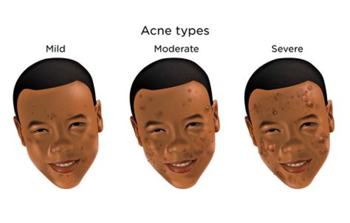 Why is my acne so bad at 27?